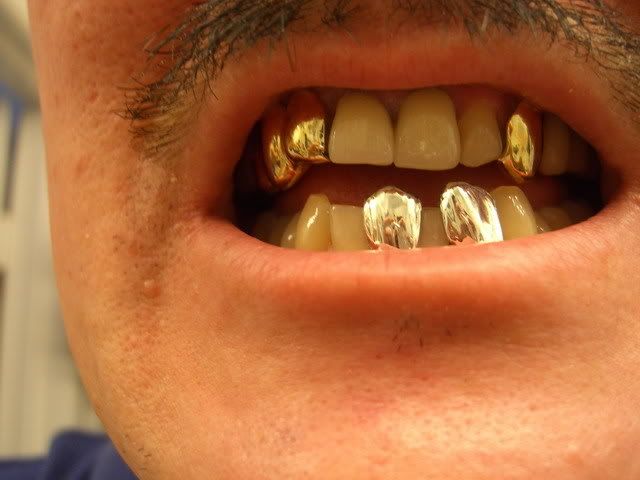 White Gold Teeth http:.therpff24how-can-i-make-gold-tooth ...