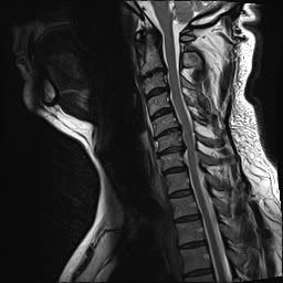 neckMRI.jpg