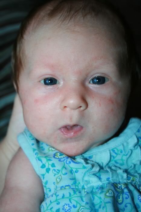 Infant Acne