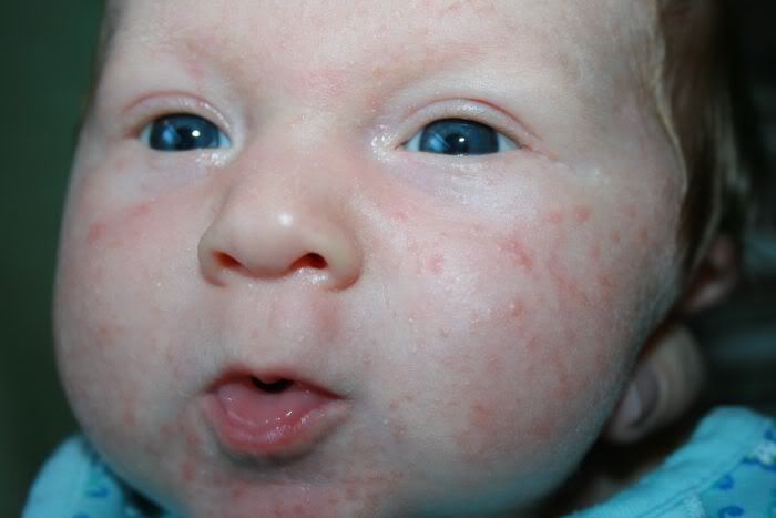INFANT ACNE infant acne: